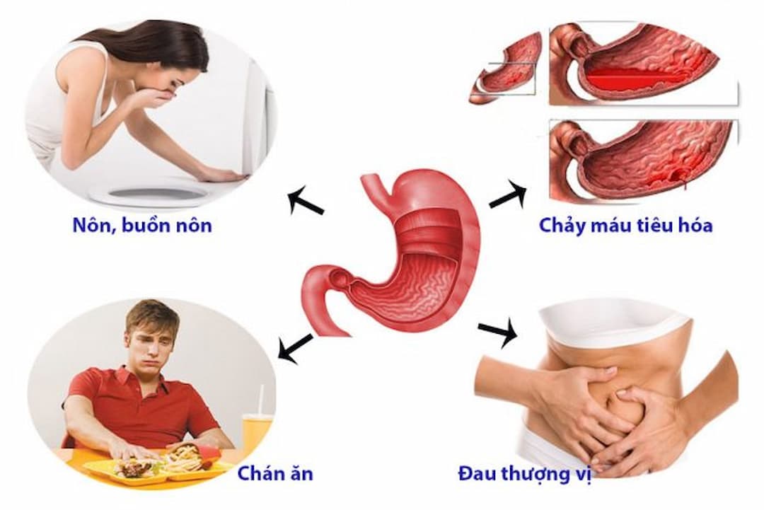 Các triệu chứng đau bao tử có thể nhận biết sớm