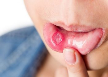 Nhiều nguyên nhân gây ra tình trạng nhiệt miệng