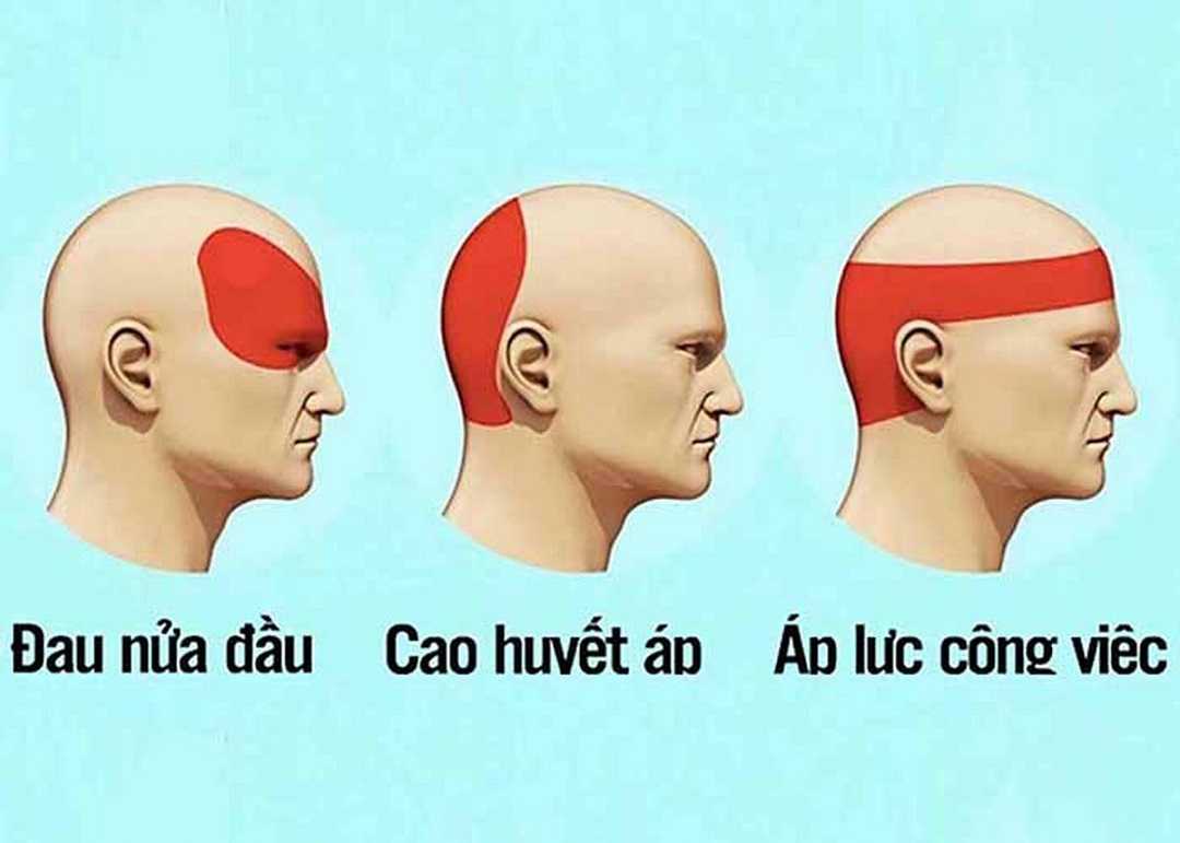 3 dạng bệnh đau đầu phổ biến là đau nửa đầu, đau đầu do cao huyết áp, đau đầu do áp lực, stress