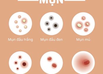 Các loại mụn dễ gặp trên cơ thể người