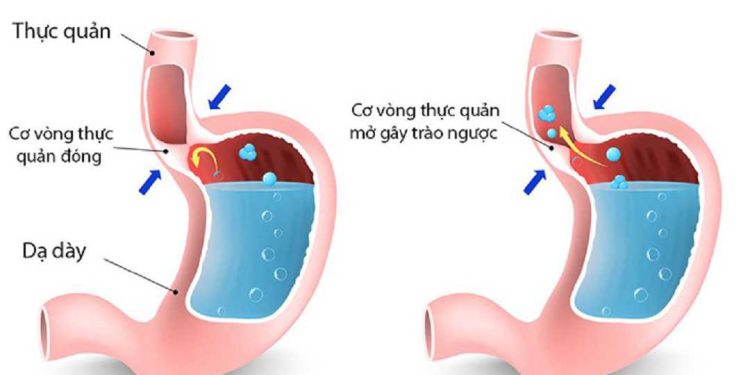Trào ngược dạ dày là tình trạng dịch vị axit từ dạ dày trào ngược lên thực quản