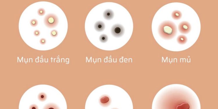 Các loại mụn dễ gặp trên cơ thể người