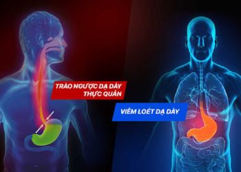 Trào ngược dạ dày và viêm loét dạ dày là hai bệnh lý khác nhau