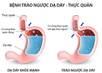 Trào ngược dạ dày là tình trạng dịch vị axit từ dạ dày trào ngược lên thực quản