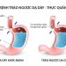 Trào ngược dạ dày là tình trạng dịch vị axit từ dạ dày trào ngược lên thực quản