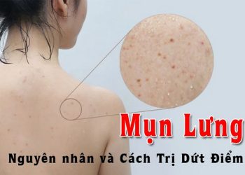 Các Yếu Tố Ảnh Hưởng Đến Hiệu Quả Điều Trị Mụn Lưng