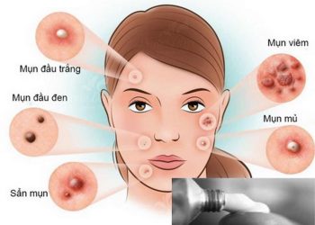Cách sử dụng Thuốc trị mụn trứng cá hiệu quả nhất