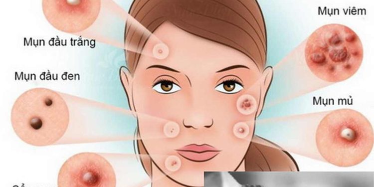 Cách sử dụng Thuốc trị mụn trứng cá hiệu quả nhất